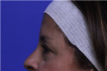 Eyelid Surgery Before Photo by Jeffrey Scott, MD; Sarasota, FL - Case 35172