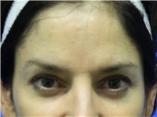 Eyelid Surgery After Photo by Jeffrey Scott, MD; Sarasota, FL - Case 35173