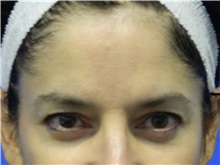 Eyelid Surgery Before Photo by Jeffrey Scott, MD; Sarasota, FL - Case 35173