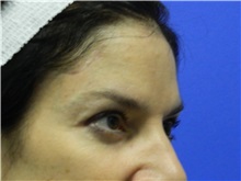 Eyelid Surgery After Photo by Jeffrey Scott, MD; Sarasota, FL - Case 35173