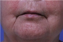 Chemical Peels, IPL, Fractional CO2 Laser Treatments After Photo by Jeffrey Scott, MD; Sarasota, FL - Case 35175