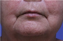 Chemical Peels, IPL, Fractional CO2 Laser Treatments Before Photo by Jeffrey Scott, MD; Sarasota, FL - Case 35175