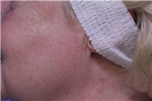 Chemical Peels, IPL, Fractional CO2 Laser Treatments After Photo by Jeffrey Scott, MD; Sarasota, FL - Case 35175