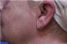 Chemical Peels, IPL, Fractional CO2 Laser Treatments Before Photo by Jeffrey Scott, MD; Sarasota, FL - Case 35175