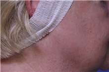 Chemical Peels, IPL, Fractional CO2 Laser Treatments After Photo by Jeffrey Scott, MD; Sarasota, FL - Case 35175