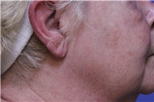 Chemical Peels, IPL, Fractional CO2 Laser Treatments Before Photo by Jeffrey Scott, MD; Sarasota, FL - Case 35175