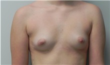 Breast Augmentation Before Photo by C. Bob Basu, MD, MBA, MPH, FACS; Houston, TX - Case 34696