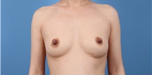 Breast Augmentation Before Photo by C. Bob Basu, MD, MBA, MPH, FACS; Houston, TX - Case 34699