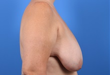 Breast Lift Before Photo by C. Bob Basu, MD, MBA, MPH, FACS; Houston, TX - Case 34702