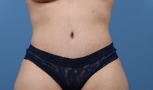 Tummy Tuck After Photo by C. Bob Basu, MD, MBA, MPH, FACS; Houston, TX - Case 34706