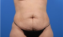 Tummy Tuck Before Photo by C. Bob Basu, MD, MBA, MPH, FACS; Houston, TX - Case 34706