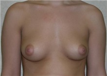 Breast Augmentation Before Photo by Manish Gupta, MD; Toledo,  - Case 8548