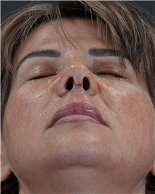 Rhinoplasty After Photo by Celal Alioglu, MD; Istanbul, M - Case 50936