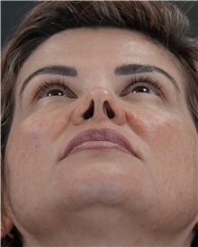 Rhinoplasty Before Photo by Celal Alioglu, MD; Istanbul, M - Case 50936