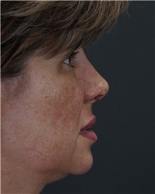Rhinoplasty After Photo by Celal Alioglu, MD; Istanbul, M - Case 50936