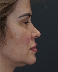 Rhinoplasty Before Photo by Celal Alioglu, MD; Istanbul, M - Case 50936