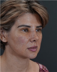 Rhinoplasty After Photo by Celal Alioglu, MD; Istanbul, M - Case 50936