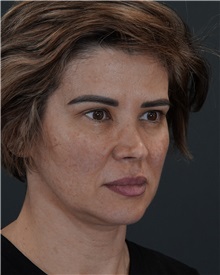 Rhinoplasty Before Photo by Celal Alioglu, MD; Istanbul, M - Case 50936