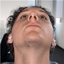Rhinoplasty After Photo by Celal Alioglu, MD; Istanbul, M - Case 51039