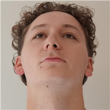 Rhinoplasty Before Photo by Celal Alioglu, MD; Istanbul, M - Case 51039