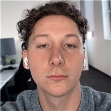 Rhinoplasty After Photo by Celal Alioglu, MD; Istanbul, M - Case 51039