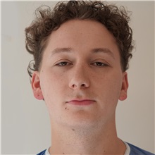 Rhinoplasty Before Photo by Celal Alioglu, MD; Istanbul, M - Case 51039