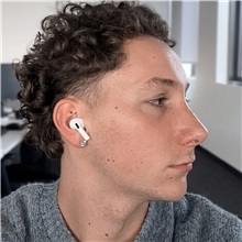 Rhinoplasty After Photo by Celal Alioglu, MD; Istanbul, M - Case 51039