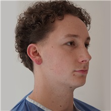 Rhinoplasty Before Photo by Celal Alioglu, MD; Istanbul, M - Case 51039
