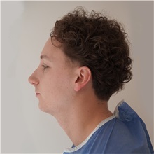 Rhinoplasty Before Photo by Celal Alioglu, MD; Istanbul, M - Case 51039