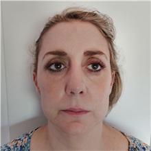 Rhinoplasty After Photo by Celal Alioglu, MD; Istanbul, M - Case 51036