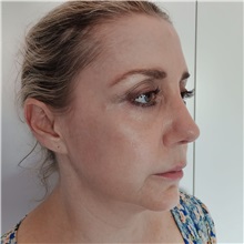 Rhinoplasty After Photo by Celal Alioglu, MD; Istanbul, M - Case 51036
