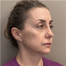 Rhinoplasty Before Photo by Celal Alioglu, MD; Istanbul, M - Case 51036