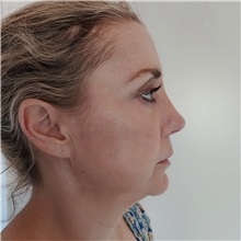 Rhinoplasty After Photo by Celal Alioglu, MD; Istanbul, M - Case 51036