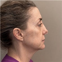 Rhinoplasty Before Photo by Celal Alioglu, MD; Istanbul, M - Case 51036