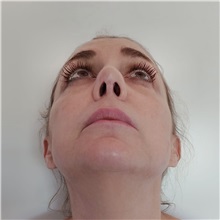 Rhinoplasty After Photo by Celal Alioglu, MD; Istanbul, M - Case 51036