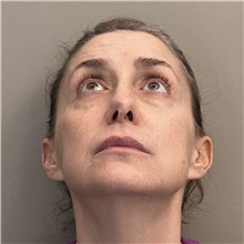 Rhinoplasty Before Photo by Celal Alioglu, MD; Istanbul, M - Case 51036