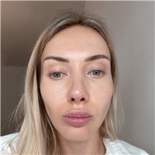 Rhinoplasty After Photo by Celal Alioglu, MD; Istanbul, M - Case 51037