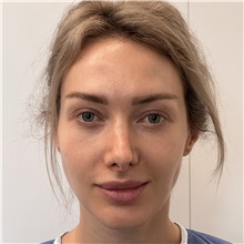 Rhinoplasty Before Photo by Celal Alioglu, MD; Istanbul, M - Case 51037
