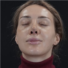 Rhinoplasty After Photo by Celal Alioglu, MD; Istanbul, M - Case 51037