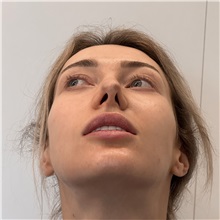 Rhinoplasty Before Photo by Celal Alioglu, MD; Istanbul, M - Case 51037