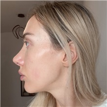Rhinoplasty After Photo by Celal Alioglu, MD; Istanbul, M - Case 51037