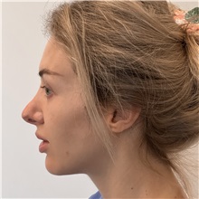 Rhinoplasty Before Photo by Celal Alioglu, MD; Istanbul, M - Case 51037