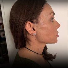 Facelift After Photo by Cem Berkay SINACI, MD; Istanbul, M - Case 50947