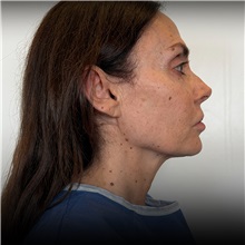 Facelift Before Photo by Cem Berkay SINACI, MD; Istanbul, M - Case 50947