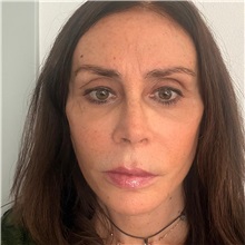 Facelift After Photo by Cem Berkay SINACI, MD; Istanbul, M - Case 50947