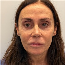 Facelift Before Photo by Cem Berkay SINACI, MD; Istanbul, M - Case 50947