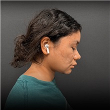 Liposuction After Photo by Cem Berkay SINACI, MD; Istanbul, M - Case 50950
