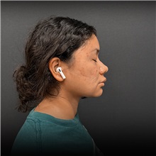 Liposuction After Photo by Cem Berkay SINACI, MD; Istanbul, M - Case 50950