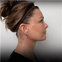 Facelift After Photo by Cem Berkay SINACI, MD; Istanbul, M - Case 50948