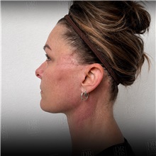 Facelift After Photo by Cem Berkay SINACI, MD; Istanbul, M - Case 50948